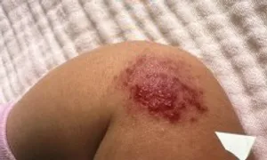 Phương pháp điều trị bướu máu ở trẻ Phương pháp điều trị bướu máu ở trẻ